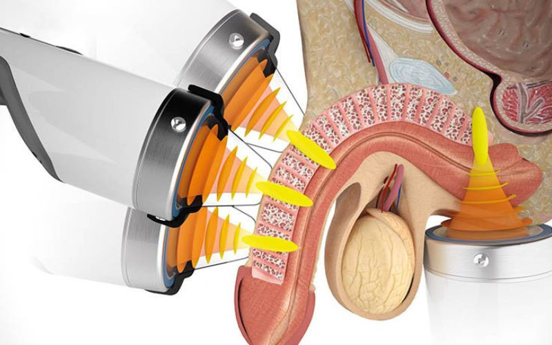 Điều trị bằng sóng xung kích