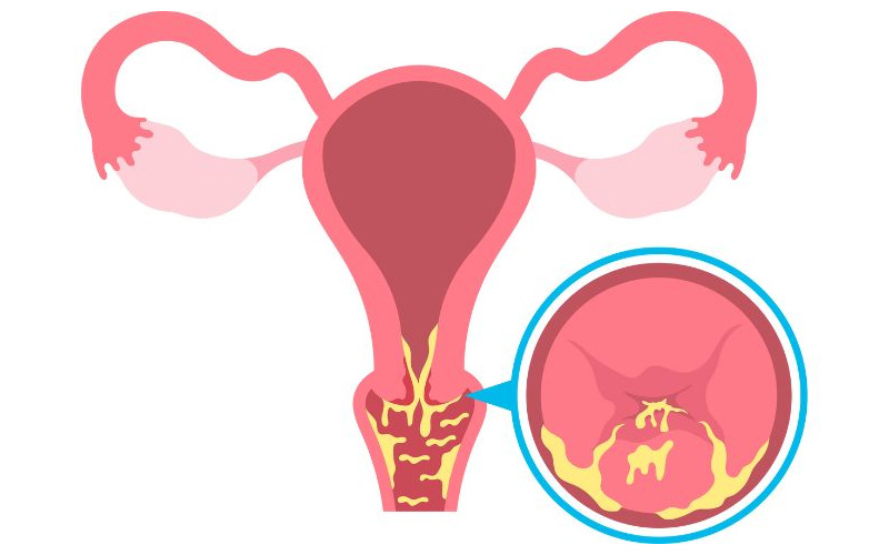 Viêm lộ tuyến không có triệu chứng rõ ràng trong giai đoạn đầu