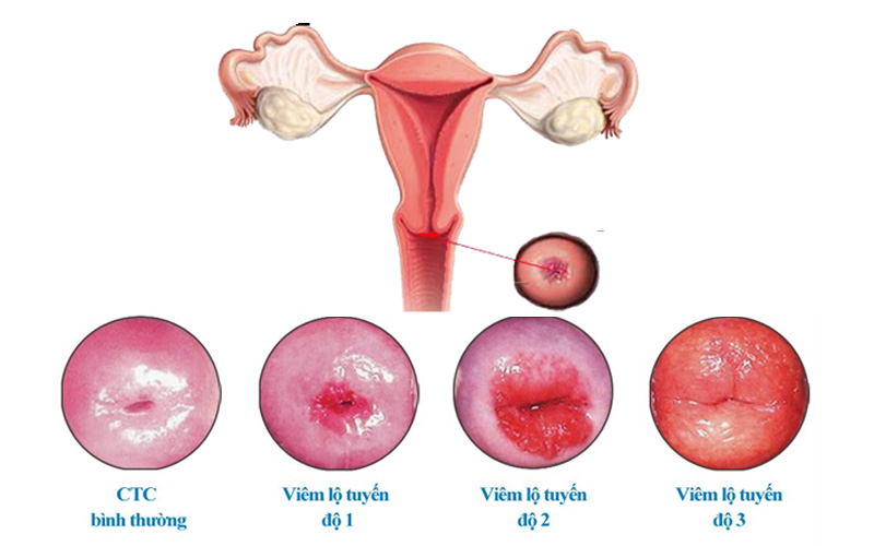 Viêm lộ tuyến cổ tử cung được chia thành 3 cấp độ