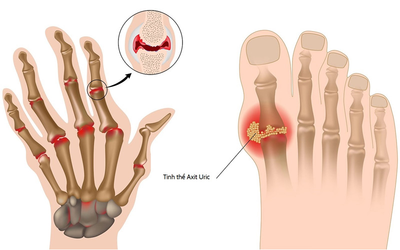 Gout khởi phát do tích tụ axit uric trong máu