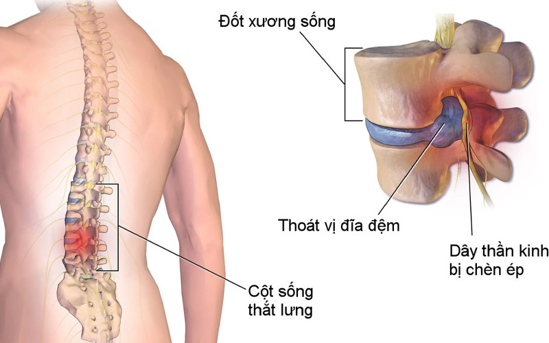 Thoát vị đĩa đệm là căn bệnh phổ biến gây ảnh hưởng đến sức khỏe