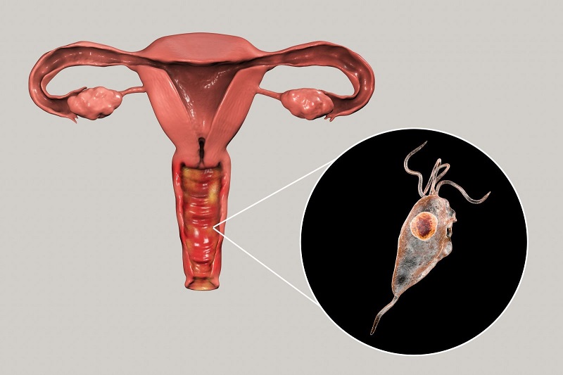 Nhiễm trùng roi Trichomonas cũng là nguyên nhân gây viêm âm đạo